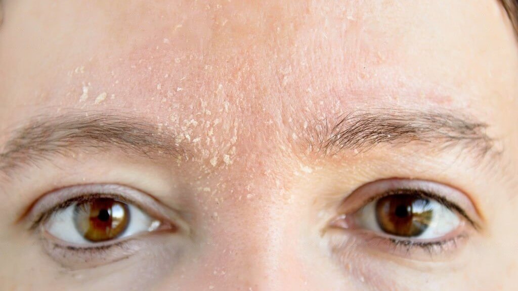 A person with dry skin, which may appear flaky or rough.